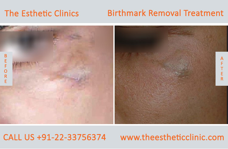 Birthmarks Removal Treatment before after photos in mumbai india (3)